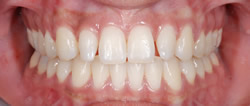 歯の隙間（歯の大きさ）の改善