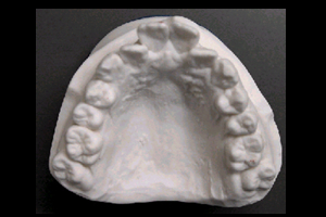 歯の型採り