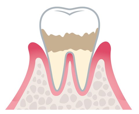 軽度歯周炎