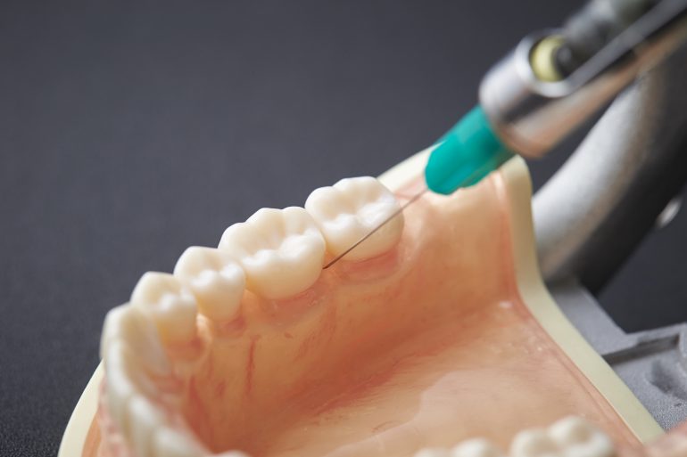 小児歯科の歯根治療